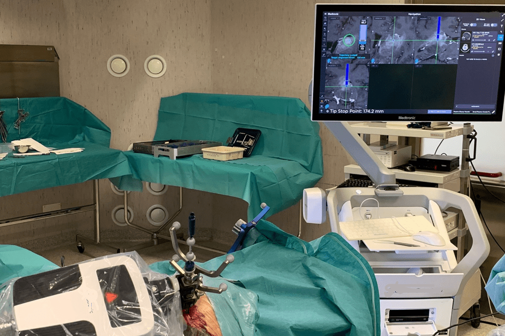 Innovativo intervento all’Aquila, braccio robotico preleva tessuto cerebrale da tumore profondo