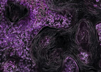 Dopo 3 anni di covid il tumore al seno torna ad essere il big killer: i dati