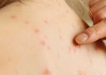Torna l’incubo morbillo, e in Abruzzo in proporzioni maggiori rispetto al resto d’Italia