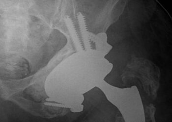 Straordinario intervento all’Aquila: impiantata una protesi su misura al posto delle ossa del bacino